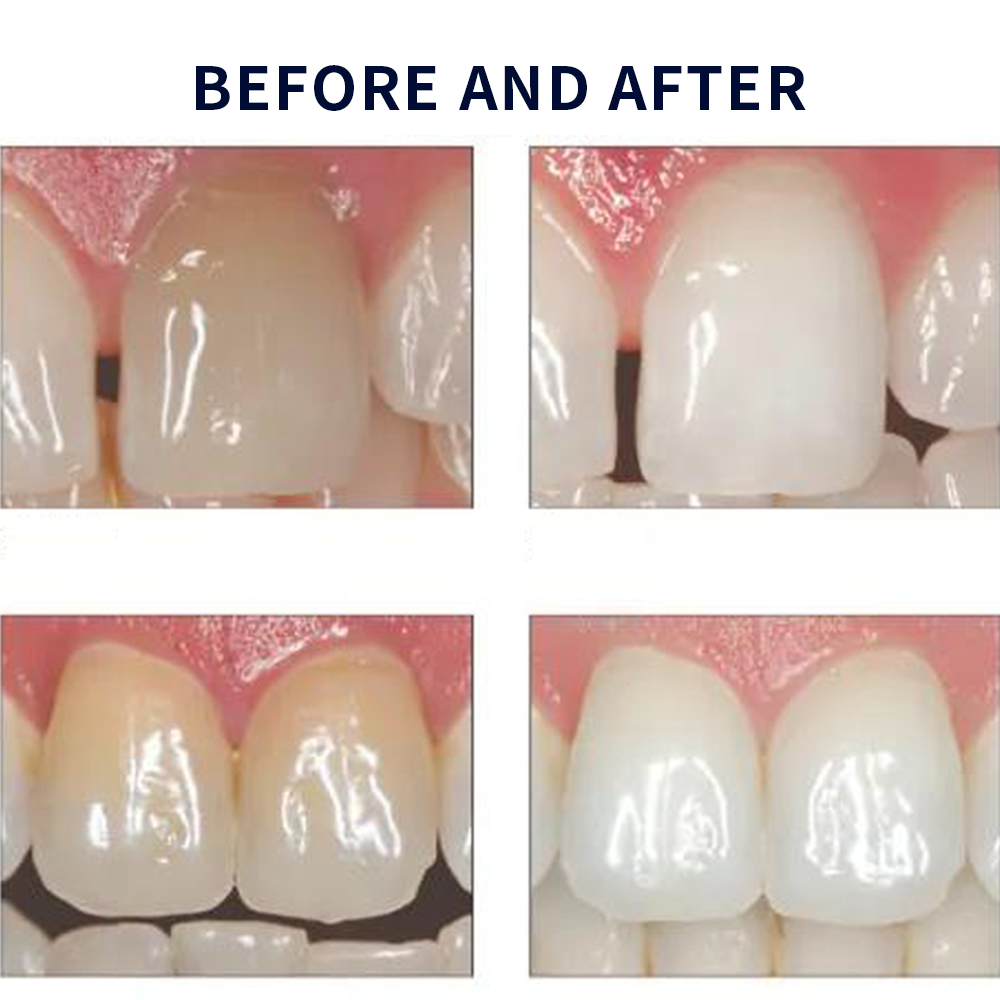 Opalescentie Whitening 20% Pf  - Teeth Whitening Gels Used By Dentists recensie en prijs