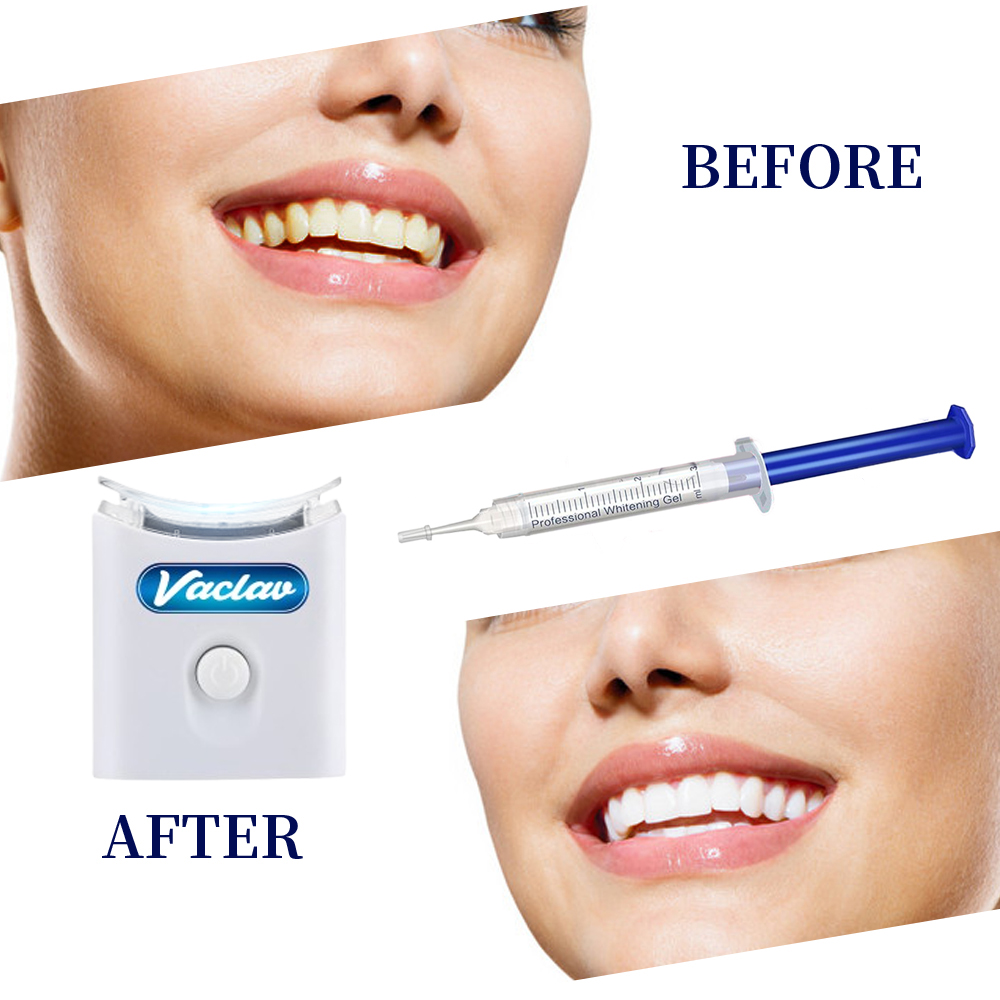 Mint Tanden Whitening Gel Spui - Teeth Whitening Kit At Home recensie en prijs