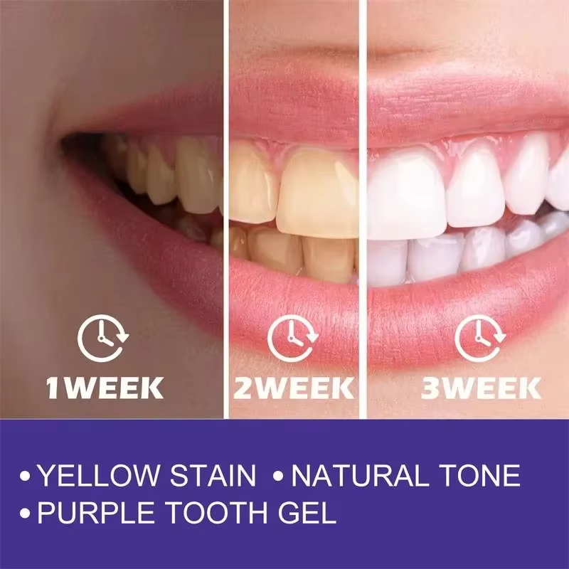 Tanden Reiniging Whitening Tan - Teeth Whitening In Korea recensie en prijs