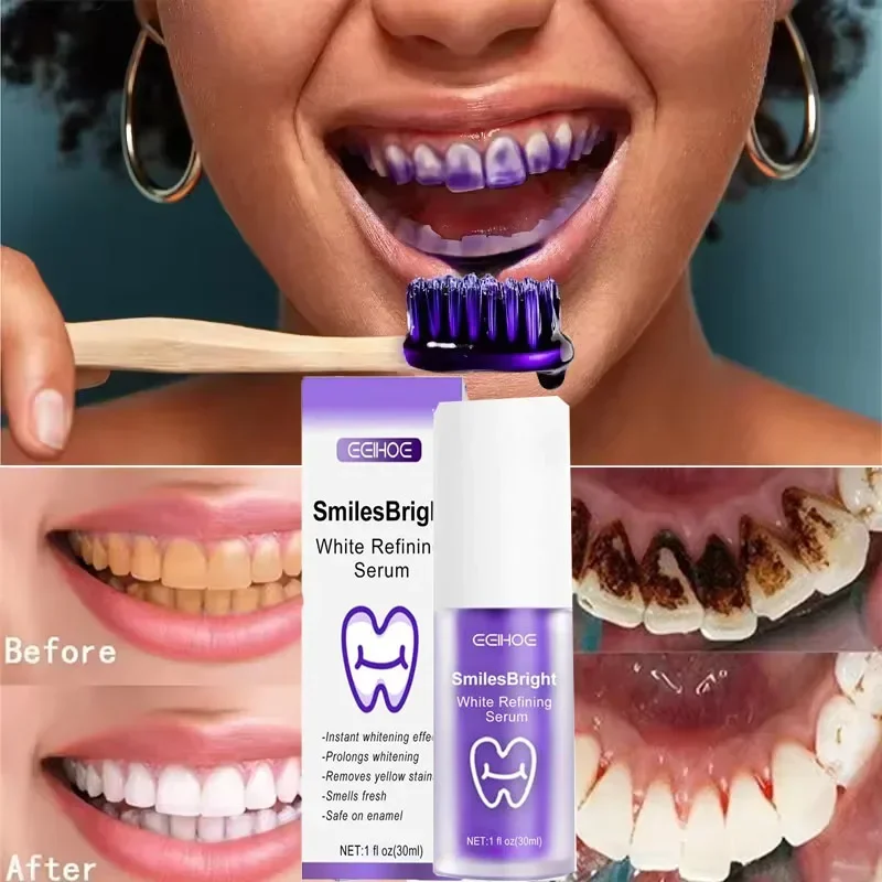 Tanden Reiniging Whitening Tan - Teeth Whitening In Korea recensie en prijs