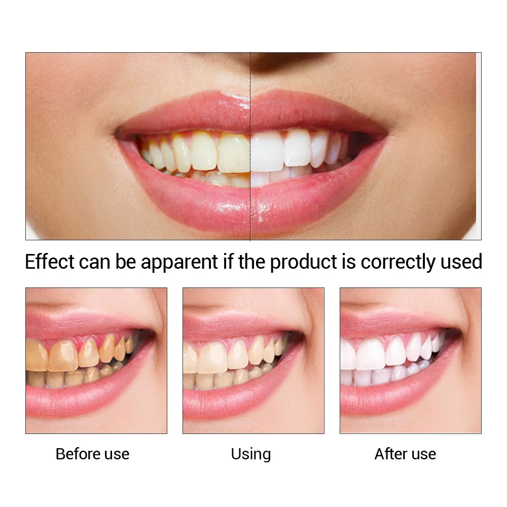 Fteenply Tanden Whitening Esse - Teeth Whitening Remedies recensie en prijs