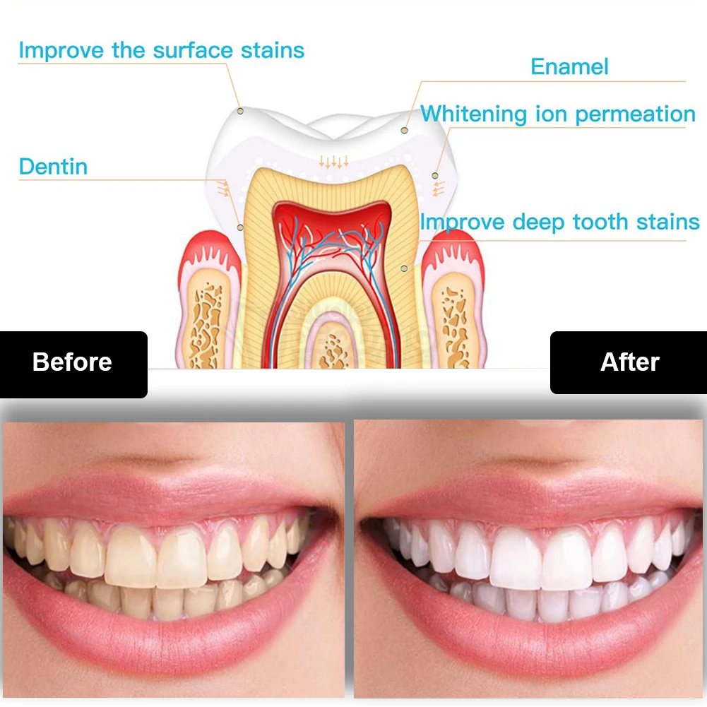 Tandheelkundige Tanden Whiteni - Teeth Whitening Pens recensie en prijs